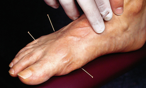 Akupunktura je stále modernější záležitostí